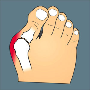 Bunions