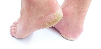 Callus and Fissures
